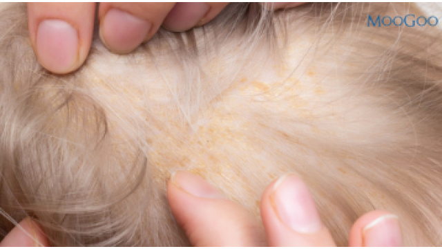 Viêm da tiết bã ở trẻ: Cách phòng ngừa và điều trị