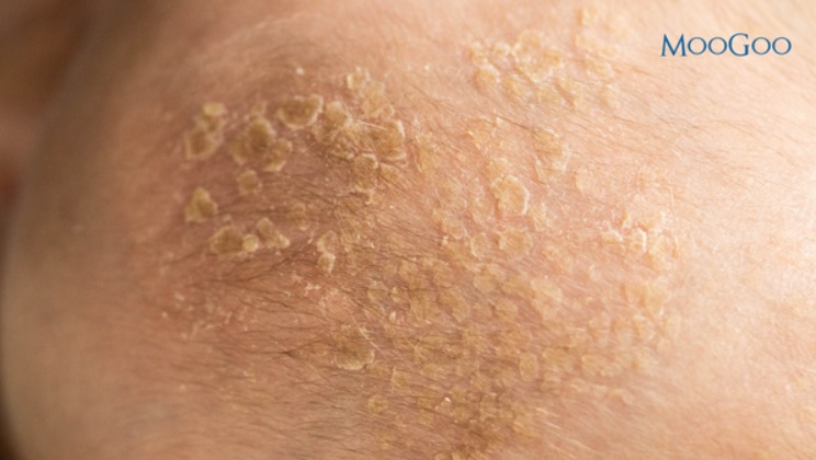 Viêm da tiết bã ở trẻ nhỏ