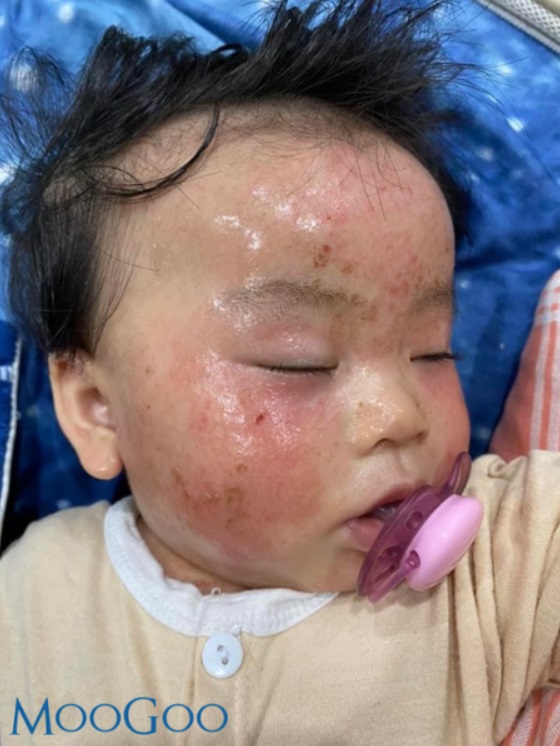 Viêm da cơ địa ở trẻ nhỏ