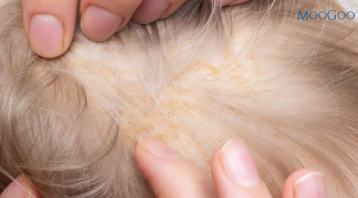 Viêm da tiết bã ở trẻ: Cách phòng ngừa và điều trị